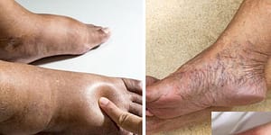 Hand with a minor injury near a rusty nail showing early warning signs of a dangerous infection